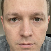 before eyebrow transplant 2