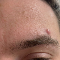 before image eyebrow cyst