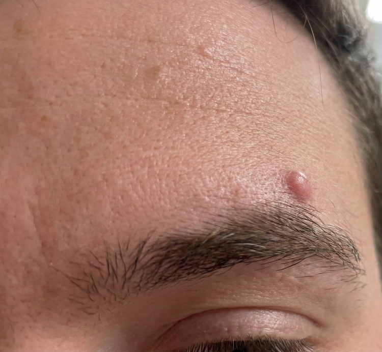 before image eyebrow cyst