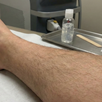 before laser hair removal