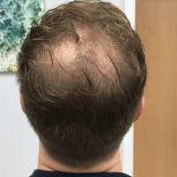 before non surgical hair treatment 1