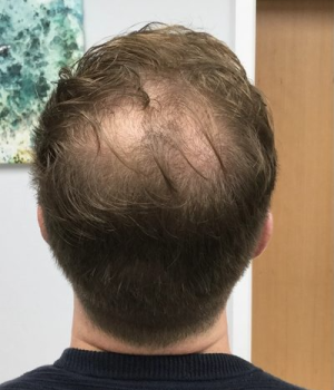 before non surgical hair treatment 1