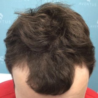 before non surgical hair treatment 2