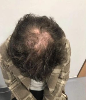 before non surgical hair treatment 3