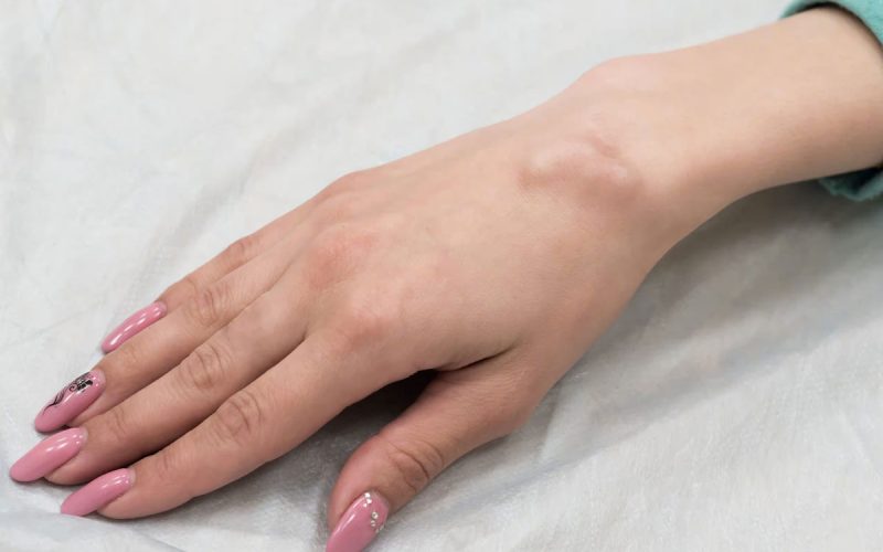 at home cyst removal