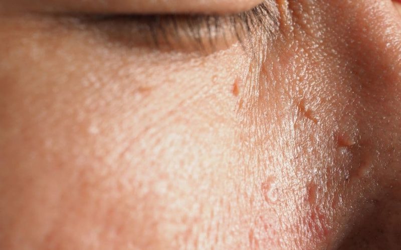 flat warts on the face