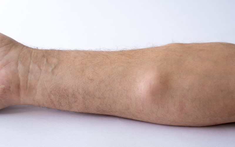lipoma liposarcoma