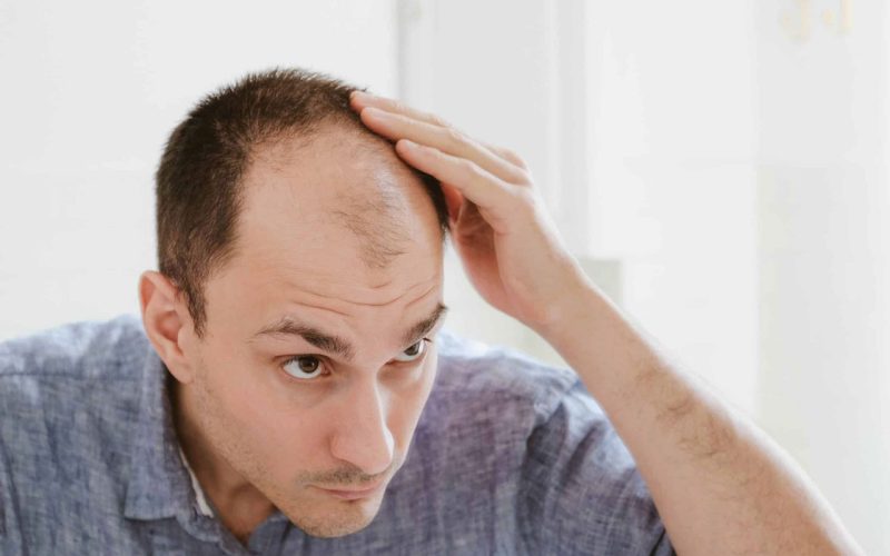 male-pattern-baldness