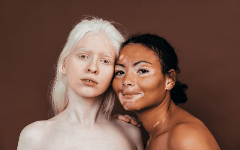 skin-coloration-diseases